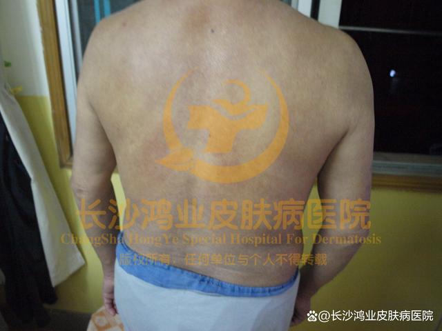 荨麻疹 荨麻疹