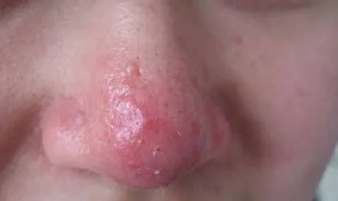酒糟鼻785 酒糟鼻785