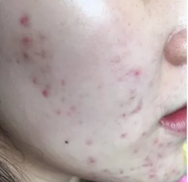 青春痘12 青春痘12