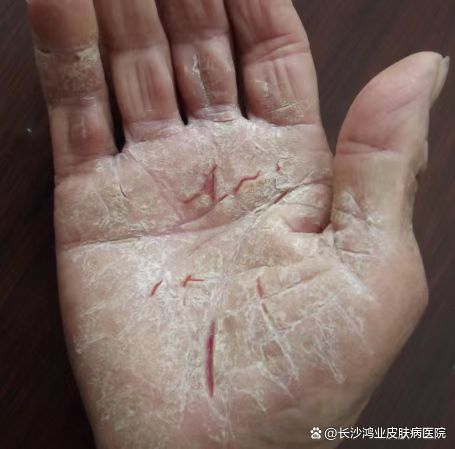 湿疹69 湿疹69