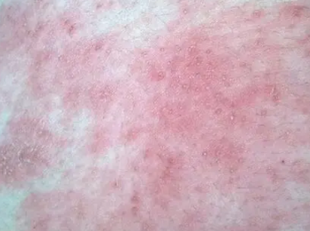过敏性皮炎45848 过敏性皮炎45848