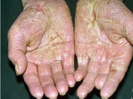 手部湿疹2