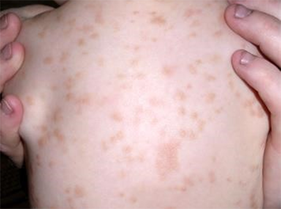 荨麻疹 (5)
