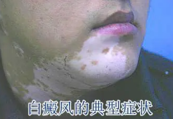 白癜风56556+ 白癜风56556+