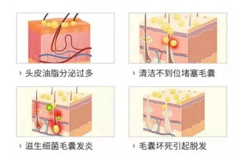 毛囊炎5656